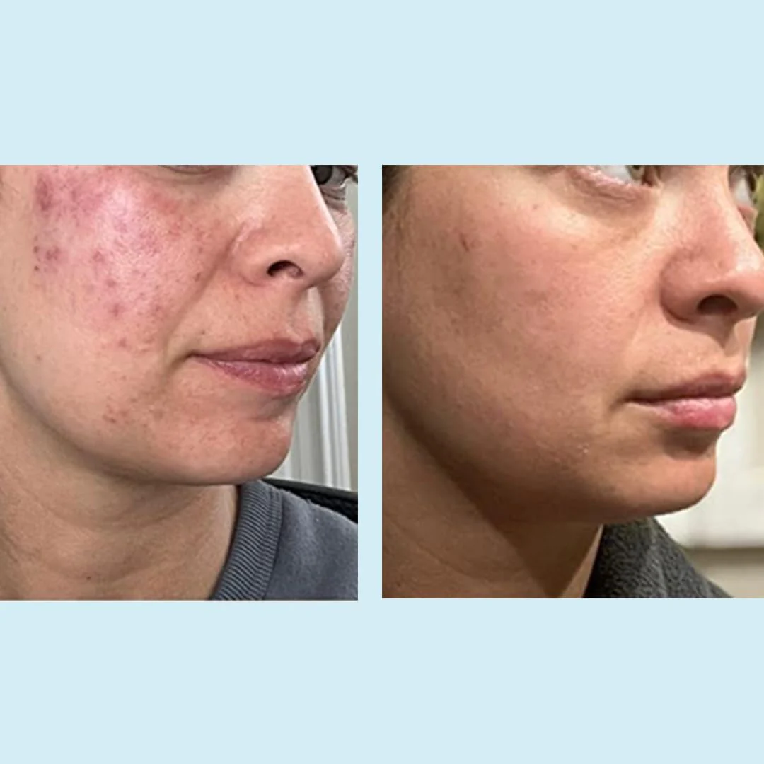 PERFECT IMAGE Glycolic Acid 50% Gel Peel - Enhanced with Retinol &a; Green Tea Extract (Professional Skin Peel)1 ounce